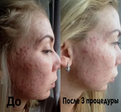 Ретиноевый пилинг для лица в Москве заказать по цене от 16000 руб. Face  Clinic