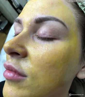 Ретиноевый (желтый) пилинг для лица у косметолога
