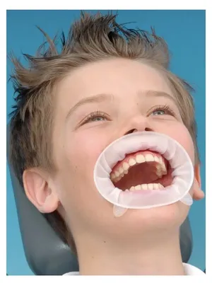 Ретрактор стоматологический двусторонний для щек и губ черный - набор из 4  шт купить в интернет-магазине dentins.ru