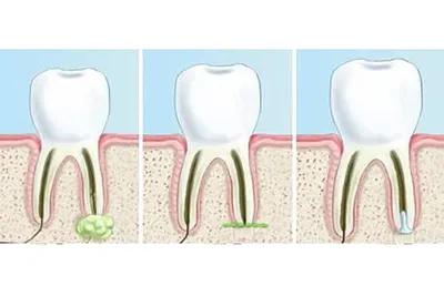 Резекция корня зуба в Казани — лечение воспалительных заболеваний корней  зуба в стоматологии Миллидент