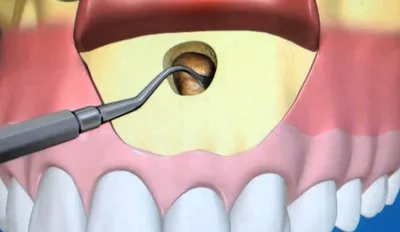 Резекция корня зуба в Москве под ключ, недорогие цены от ДантистоФФ