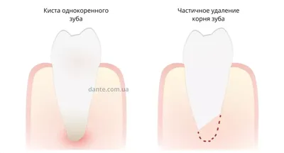 ≡ Резекция верхушки корня зуба в Киеве — метро Олимпийская: цены и отзывы о  клинике D.Ante