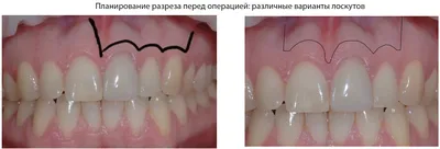 Резекция верхушки корня зуба - цена в Киеве | Стоматологическая клиника  PORCELAIN