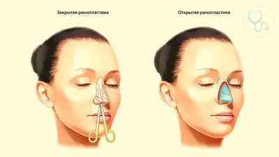 Ринопластика носа в Минске (Беларуси) цена, стоимость операции ринопластика