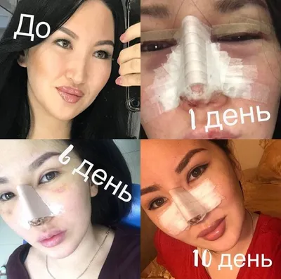 Ринопластика в Москве по цене от 201500 руб. в клинике Beauty Trend