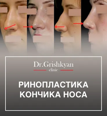 Фото до и после — Пластика носа (ринопластика) — клиника Seline