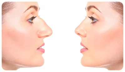 ринопластика | Укорочение носа | Сужение ноздрей | Коррекция искривленного  носа | нос крючком | коррекция большого носа | коррекция широкого носа