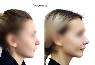 Фото до и после ринопластики - коррекции носа