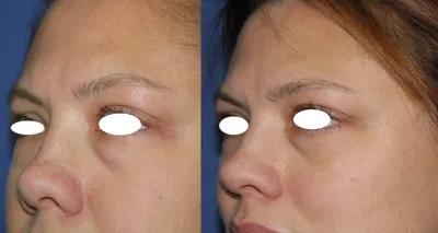 Синяки под глазами после ринопластики: советы от Клиники Доктора Росс