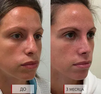 Ринопластика: корректируем горбинку носа - Cosmetic-clinic