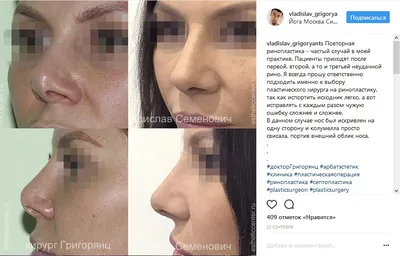 Неудачная ринопластика носа. Фото до и после.