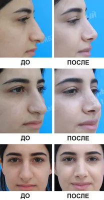 Пластика носа (ринопластика): стоит ли делать? - Клиника в Уручье