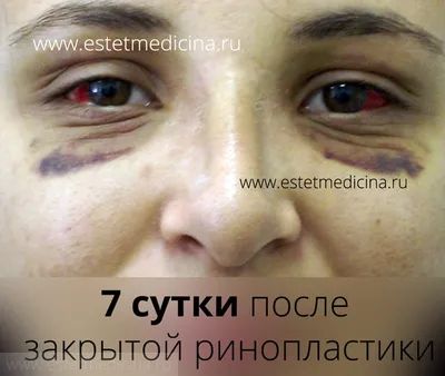 Ринопластика (пластика носа) пластическая хирургия носа: цена, хирург, фото  | Интернет-журнал Estetmedicina.ru