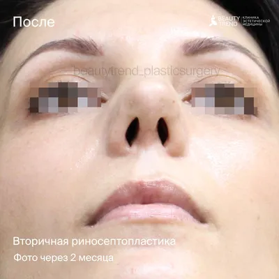 Ринопластика (пластика носа) пластическая хирургия носа: цена, хирург, фото  | Интернет-журнал Estetmedicina.ru