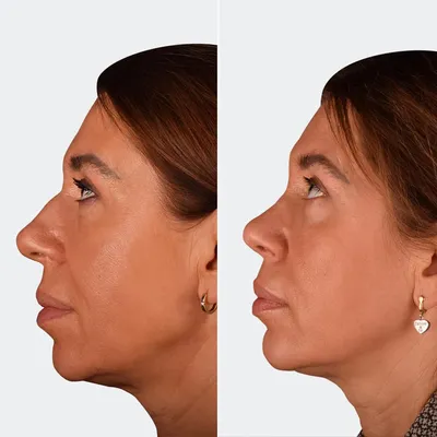 Открытая ринопластика носа - отзывы, фото и видео операции