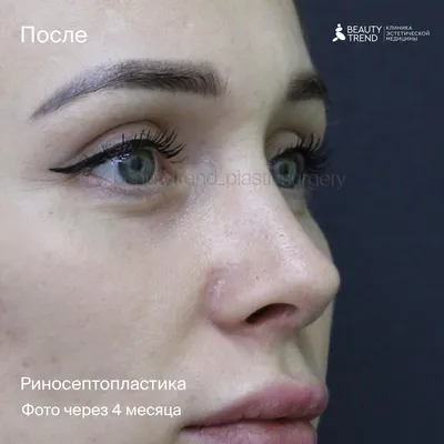 Ринопластика - Vista Dental - Пластическая хирургия носа Кременчуг