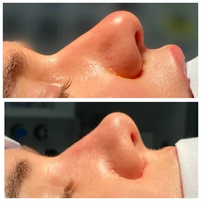 Хочу отметить,что кожа очень толстая￼ #ринопластика #rhinoplastica  #rhinoplasticayerevan #ռինոպլաստիկաերևան #rhino #rhinoplasty… | Instagram