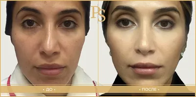 Хочу отметить,что кожа очень толстая￼ #ринопластика #rhinoplastica  #rhinoplasticayerevan #ռինոպլաստիկաերևան #rhino #rhinoplasty… | Instagram