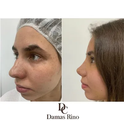 Ринопластика носа с толстой кожей в Москве - Damas Medical Center
