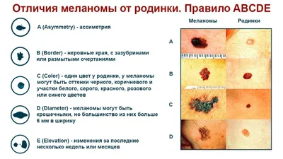 FAQ: Правда ли, что, если повредить родинку, можно умереть?