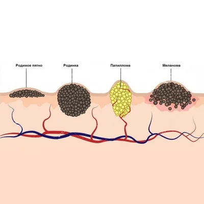 Родинки бородавки фото фото