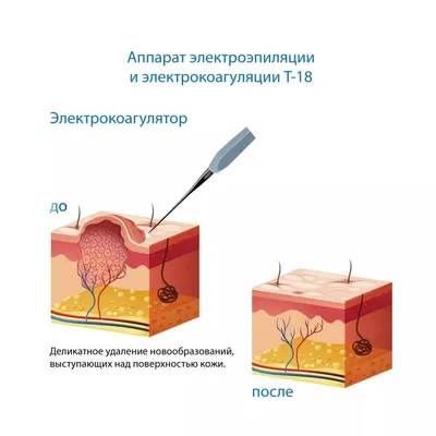 Лечение папиллом, бородавок