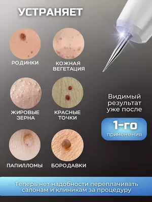 Удаление папиллом, бородавок, родинок в Новосибирске радиоволновым методом  на аппарате Фотек в медицинском центре Блеск - цена,отзывы, видео.