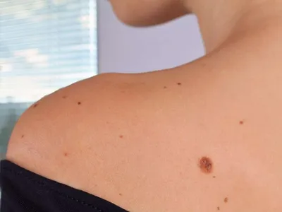Специалисты НМИЦ онкологии разработали памятку по раннему выявлению  меланомы кожи