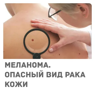 Меланома кожи - симптомы, диагностика и методы лечения | Daily Medical
