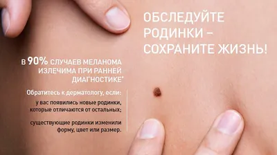 Как отличить родинку от меланомы и можно ли удалять родинки на коже - 30  мая 2023 - 74.ru