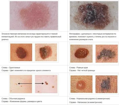 Родинки: появление на теле и на лице, почему растут, лечение, профилактика