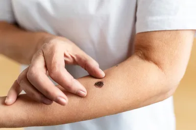 Что такое рак кожи и как уберечься от меланомы