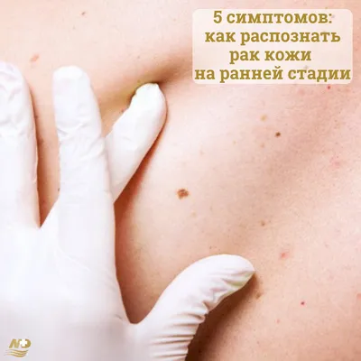 Причины и симптомы рака кожи – информационные материалы от специалистов  клиники