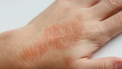 Хроническое воспаление кожи сильно отравляет жизнь