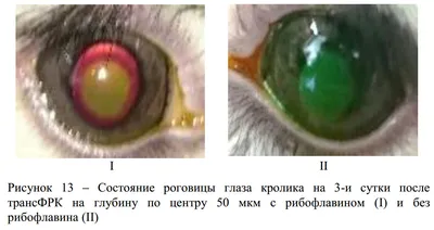 Фотографии глаза макротипа. Keratoconus прореживания заболевания глаз 2  градусов роговицы в форме конуса. Роговица пластиковая Стоковое Фото -  изображение насчитывающей заболевание, рассмотрение: 194043676