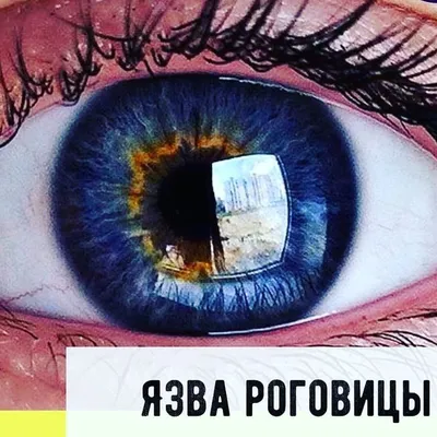 Фотографии глаза макротипа. Прореживания заболевания глаз Keratoconus  роговицы в форме конуса. Роговица пластиковая. Офтальмология Стоковое  Изображение - изображение насчитывающей коррекция, фокус: 209464013