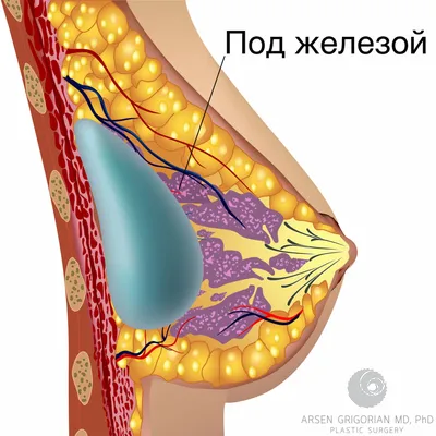 Подтяжка груди на имплантах