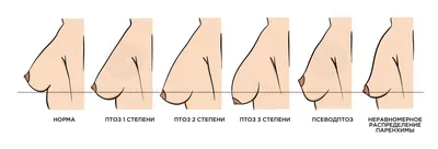 Подтяжка груди на имплантах