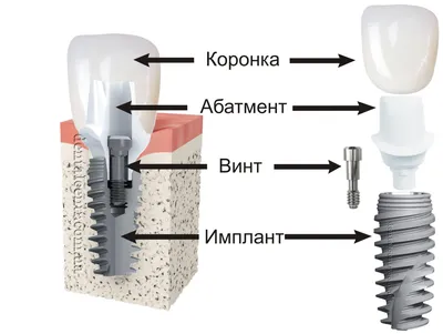 Абатмент – технический инструмент клиники ЦКС