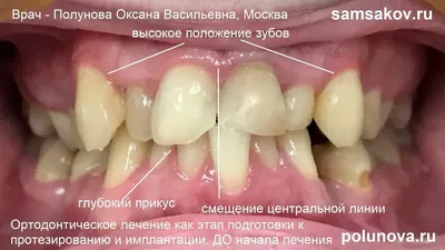 Как подготовить зубы при пародонтите под коронки и виниры с помощью  брекетов Damon Q - Альянс бьюти-стоматологов, Москва