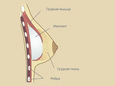 Виды и стоимость грудных имплантов: комментарии и советы от хирургов |  Клиника Доктора Росса