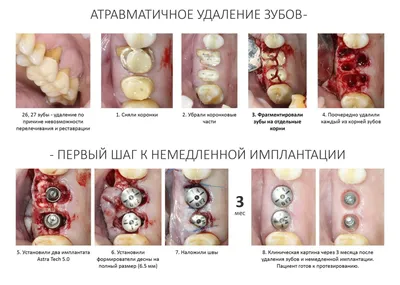 Сужение верхней и нижней челюсти, краудинг, ротация 21,33,32,42,43. Наши  работы. О нас. «Нео смайл»