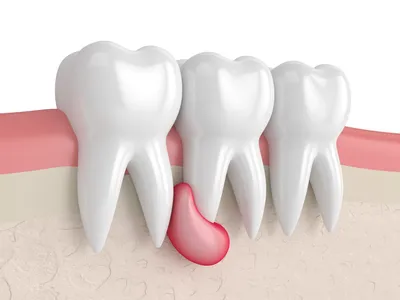 Периостит челюсти и зуба (флюс): симптомы и причины заболевания, дигностика  и лечение