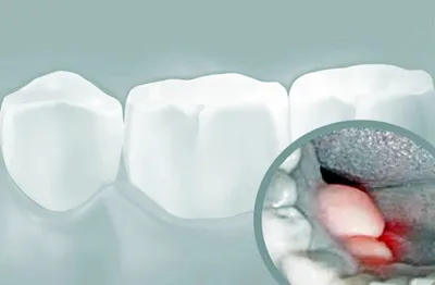Пульпит зуба: лечение, цена в Москве удаления нерва, вылечить трехканальный  зуб в клинике стоматологии, консультация