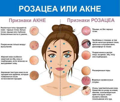 Розацеа лица (розовые угри) - причины, симптомы, диагностика, лечение