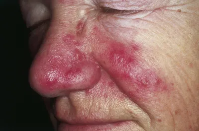 On Clinic Bishkek - Розацеа (от латинского Acne rosacea — розовые угри)  встречается чаще у людей со светлой кожей, преимущественно среди женщин. ⠀  Заболевание начинается, как правило, в 30-40лет и достигает пика