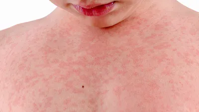 Pityriasis... - Андрій Наліжитий Дерматологія Косметологія | Facebook