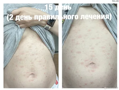 Pityriasis... - Андрій Наліжитий Дерматологія Косметологія | Facebook