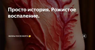 Рожа: клинико-диагностические и лечебно-профилактические аспекты – тема  научной статьи по клинической медицине читайте бесплатно текст  научно-исследовательской работы в электронной библиотеке КиберЛенинка