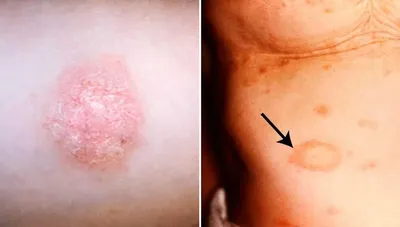 Некоторые кожные болезни: отрубевидный и розовый лишай